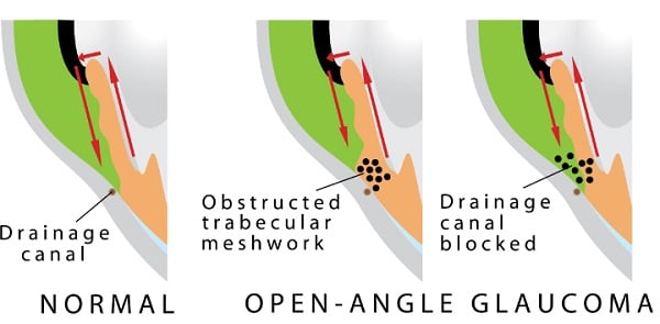 Primary open angle glaucoma